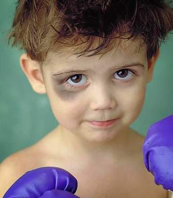 Почему у ребенка синяки под глазами и когда это причина патологии, требующей лечения