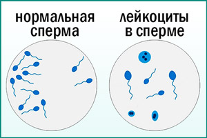 Лейкоциты в сперме