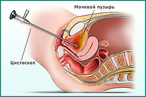 Процедура цистоскопии