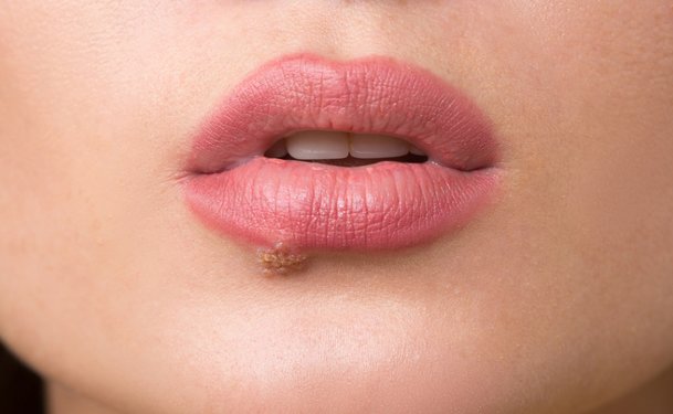 Что делать при появлении папилломы на губах
