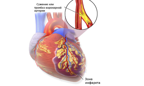 инфаркта миокарда