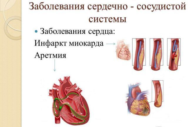 Расстройства сердечно-сосудистой системы
