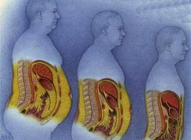 Ожирение поджелудочной железы