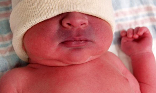 У новорожденных цианоз