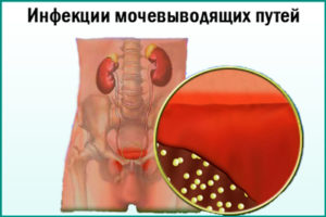 Инфекции мочевыводящих путей