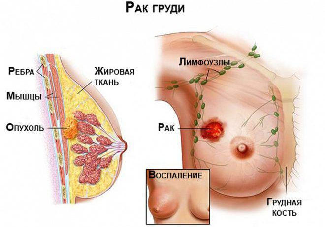 Наличие раковой опухоли на груди