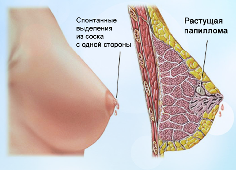 Какие симптомы папилломы в протоке молочной железы