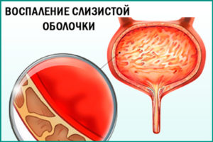 Цистит: воспаление слизистой оболочки мочевого пузыря