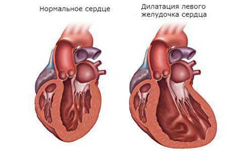 Дилатация предсердий