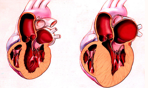 Гипертрофическая кардиомиопатия сердца