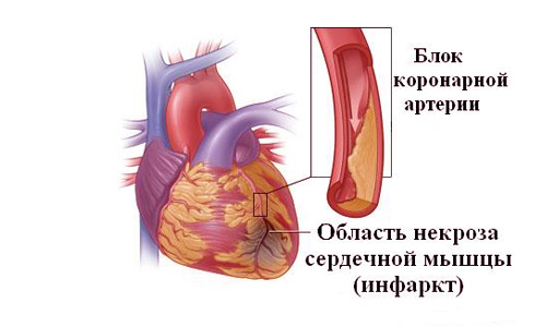 гипертония после инфаркта