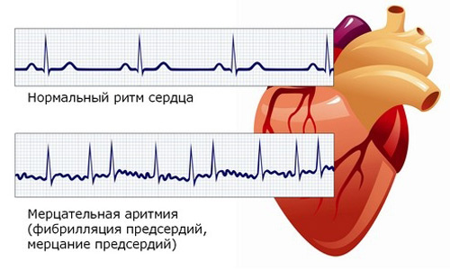 аритмия сердца