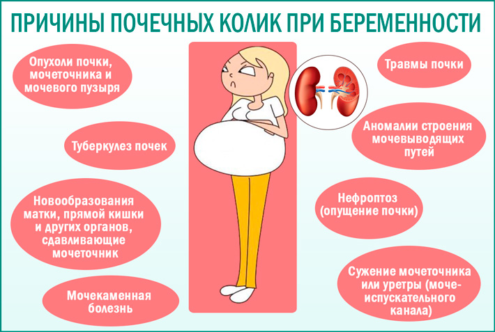Причины почечных колик у беременной