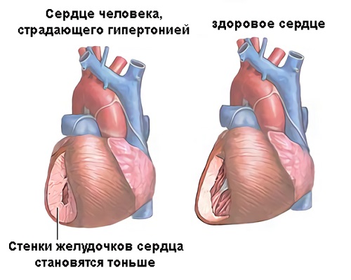 сердце при гипертонии