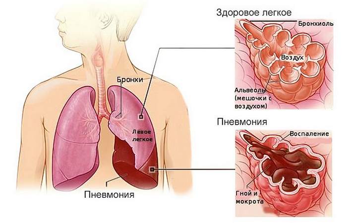 симптомы бронхопневмонии 