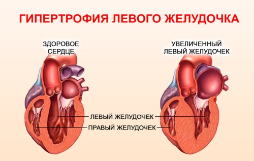 гипертрофия левого желудочка сердца