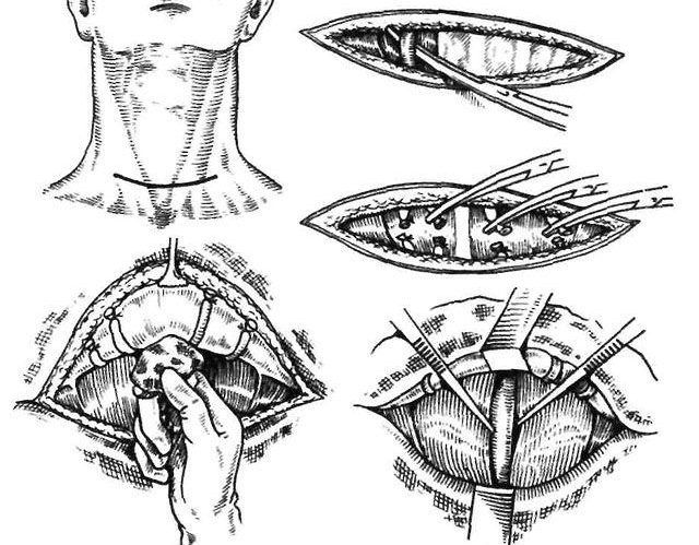 Этапы струмэктомии на щитовидной железе