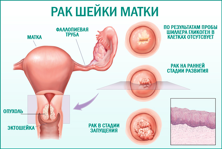 Рак шейки матки: признаки