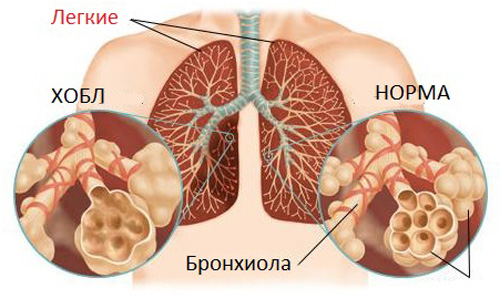 хроническая обструктивная болезнь лёгких 