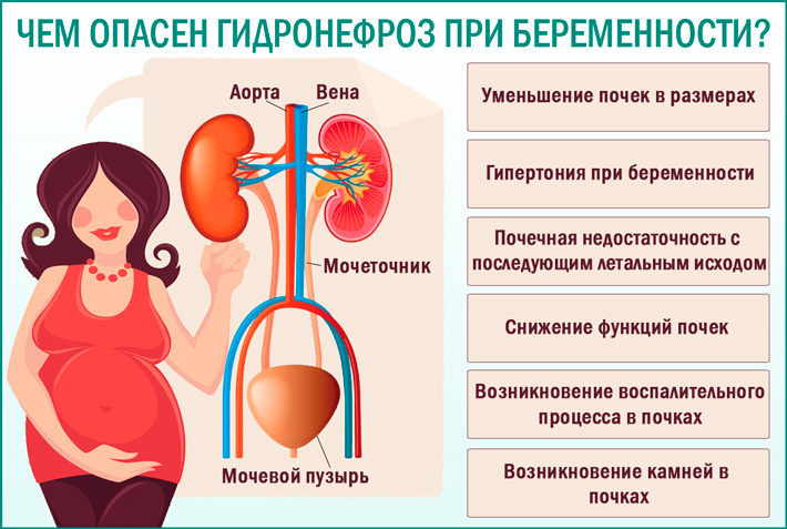 Гидронефроз во время беременности: симптомы