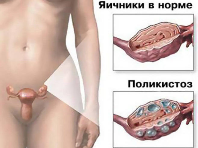 Синдром поликистозных яичников (спкя)