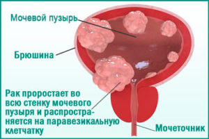 Рак мочевого пузыря: симптомы