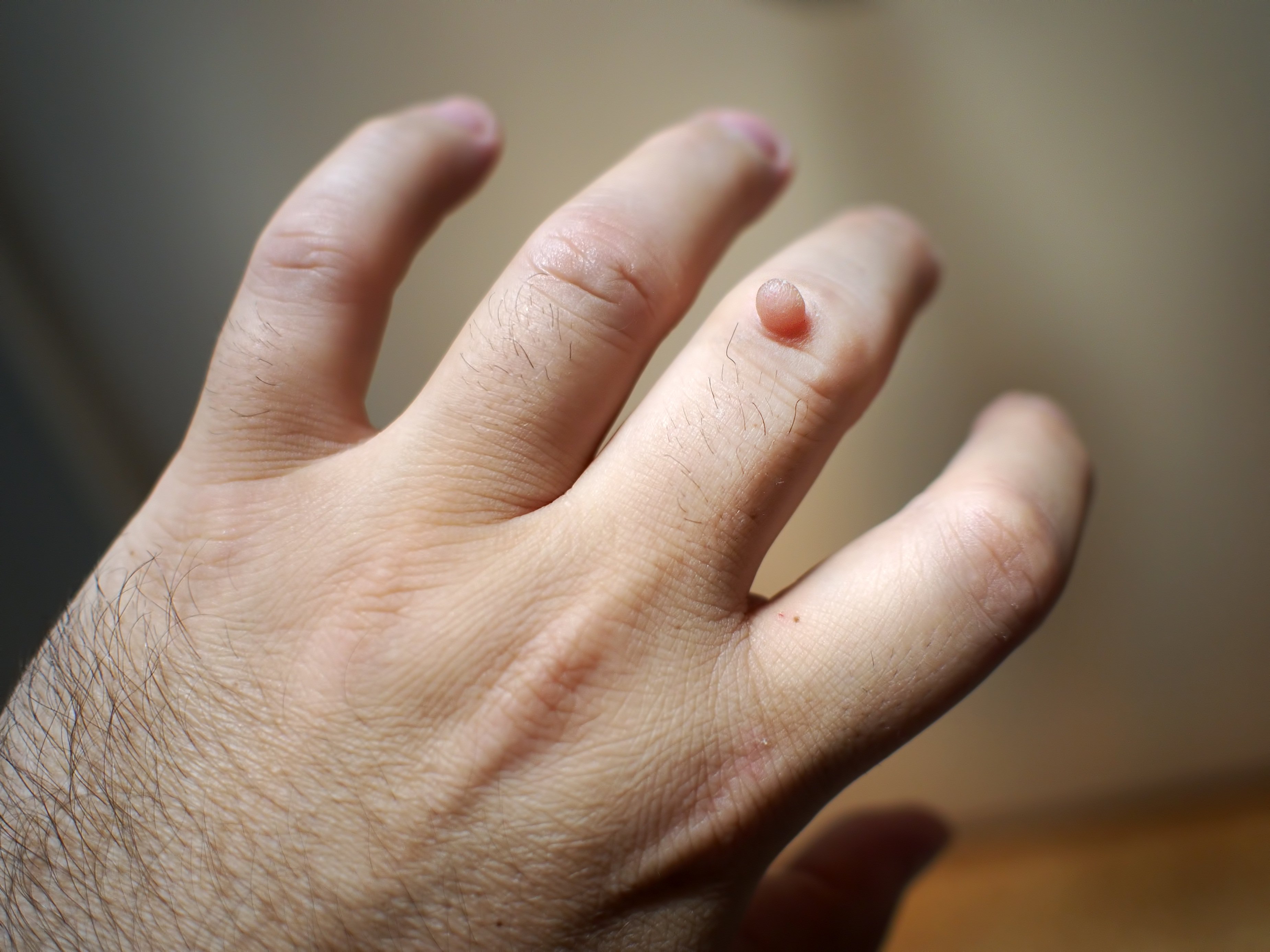 Бородавки на пальце руки – чем лечить?