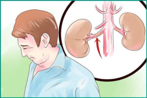 Тромбоз и эмболия почечных артерий