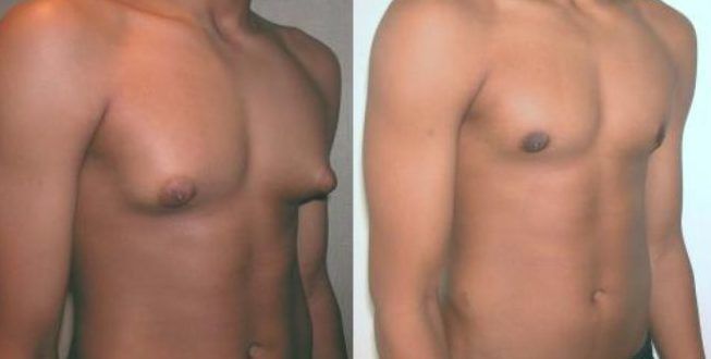 Рост груди у мужчин