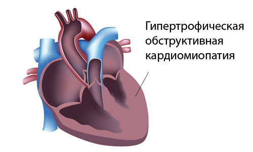 Гипертрофическая обструктивная кардиомиопатия