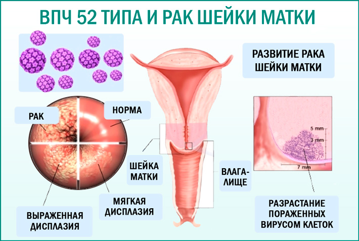 ВПЧ и рак шейки матки у женщины