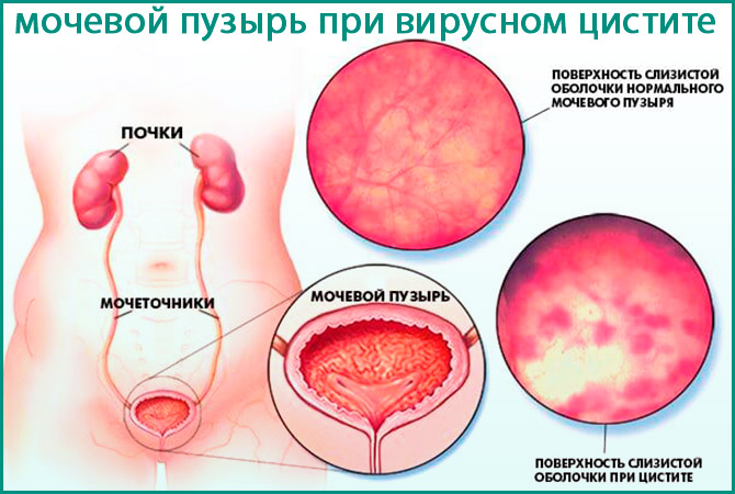 Мочевой пузырь при вирусной форме болезни