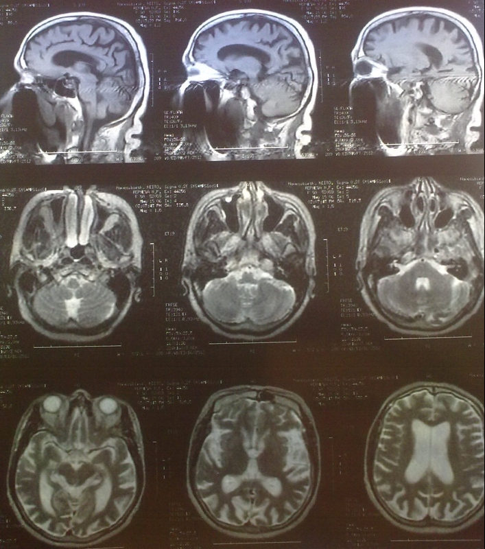 Диффузный характер головного мозга. Магнитно резонансная томография головного мозга энцефалопатия. Энцефалопатия на мрт. Диффузные изменения головного мозга на мрт. Дисциркуляторной энцефалопатии.