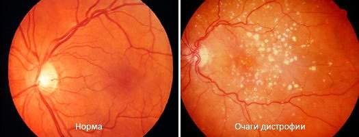 ТОП-10 витаминов для глаз для улучшения зрения взрослым и детям