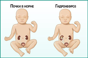 Гидронефроз у ребенка