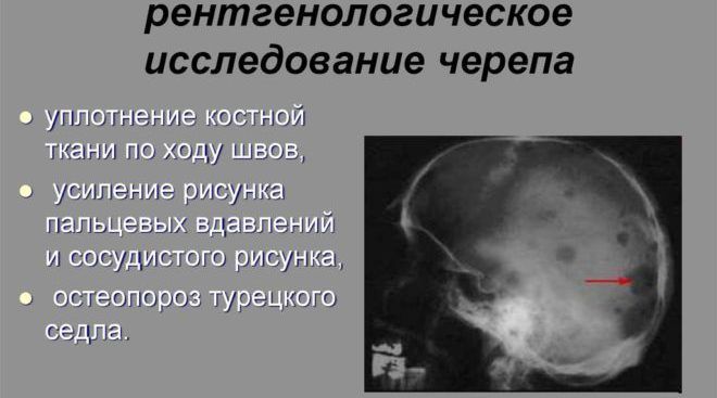 Рентгенографическое исследование черепа