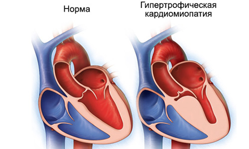 Гипертрофическая кардиомиопатия 