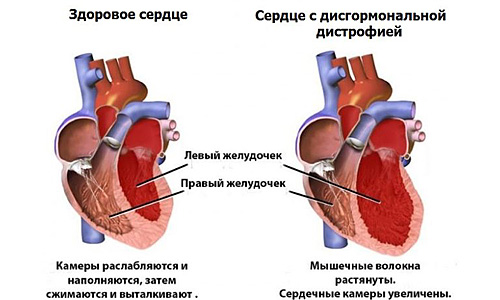возникает дистрофия сердечной мышцы