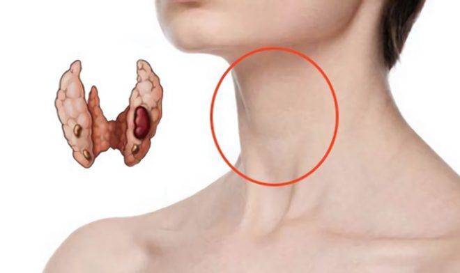 ХАИТ щитовидной железы