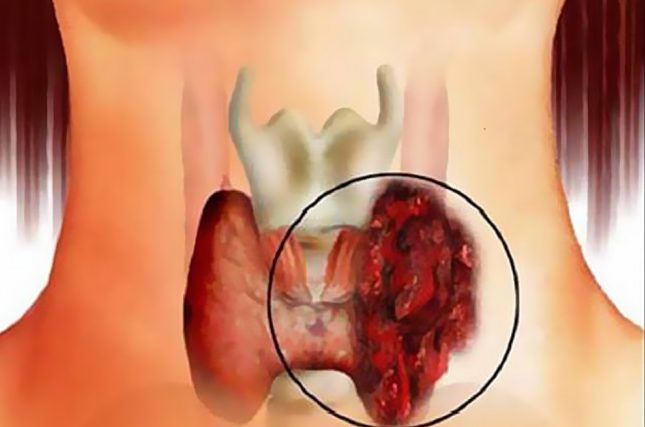 Злокачественного опухоль в щитовидной железе