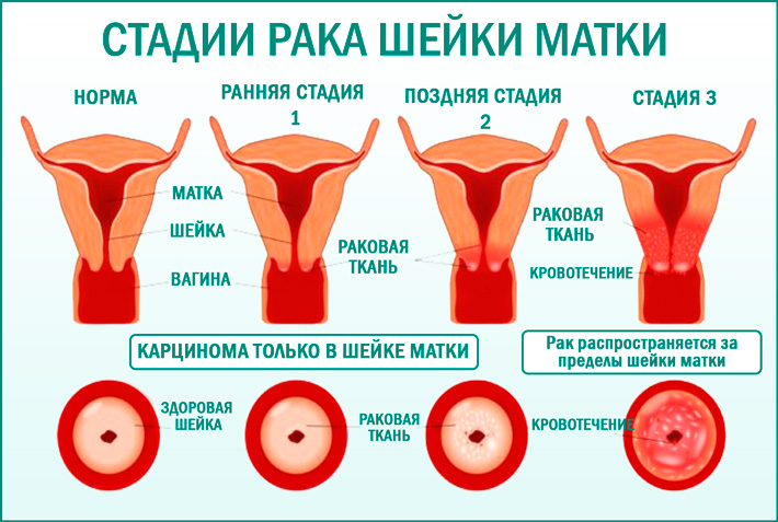 Рак шейки матки: стадии 