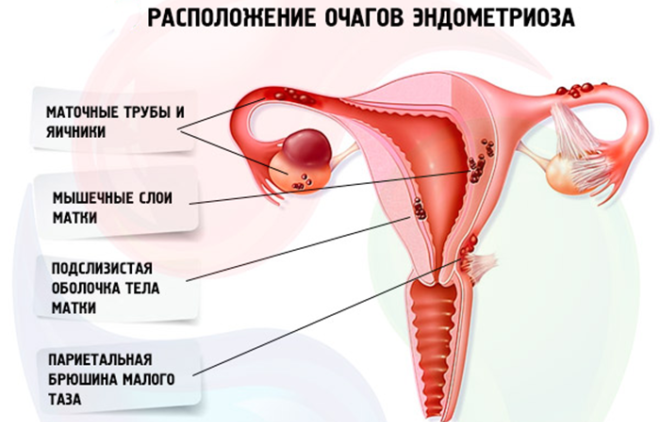 Расположение очагов при эндометриозе