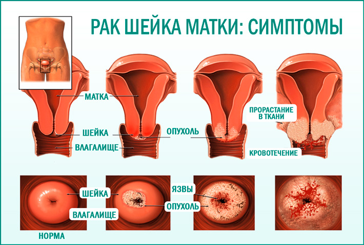Симптомы рака шейка матки
