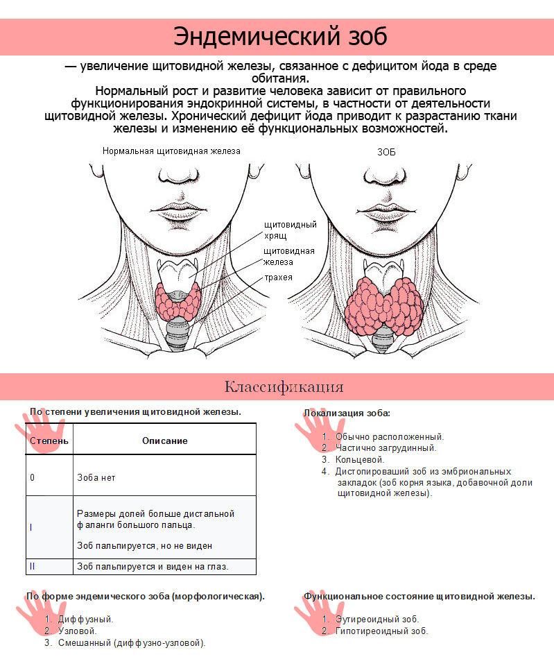 Эндемический ЗОБ — увеличенная щитовидная железа 2