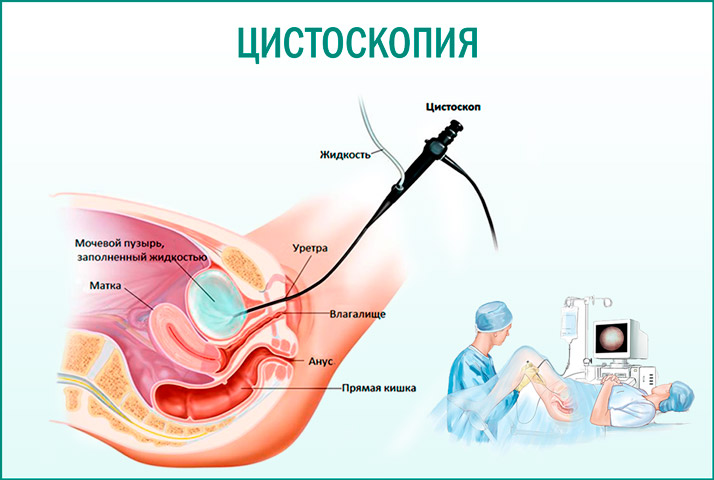 Проведение цистоскопии