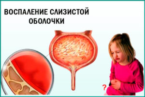 Лечение цистита у детей