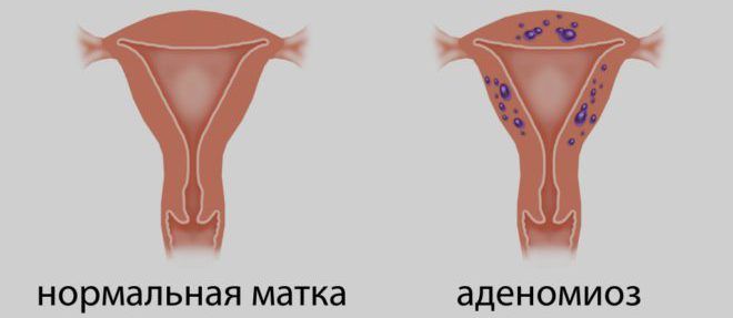 Аденомиоз матки - стадии