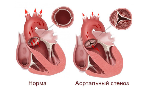 аортальный стеноз
