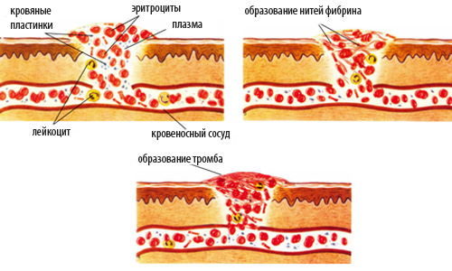 процесс образования тромба