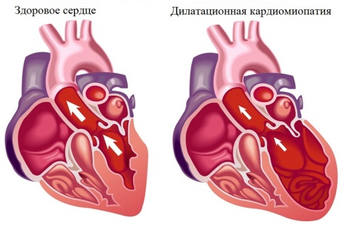дилатационная кардиомиопатия